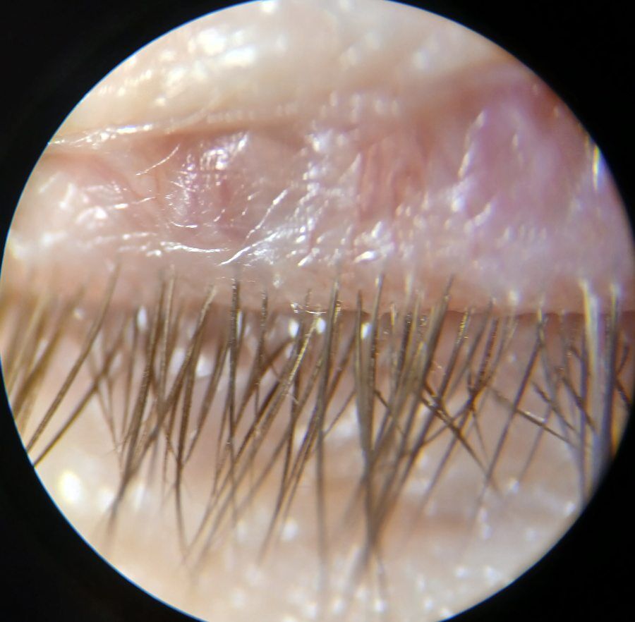 The same eyelid after one EyeClean session: clean lashes