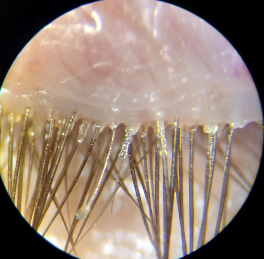 Eyelid before treatment: crusts and debris at the lashes